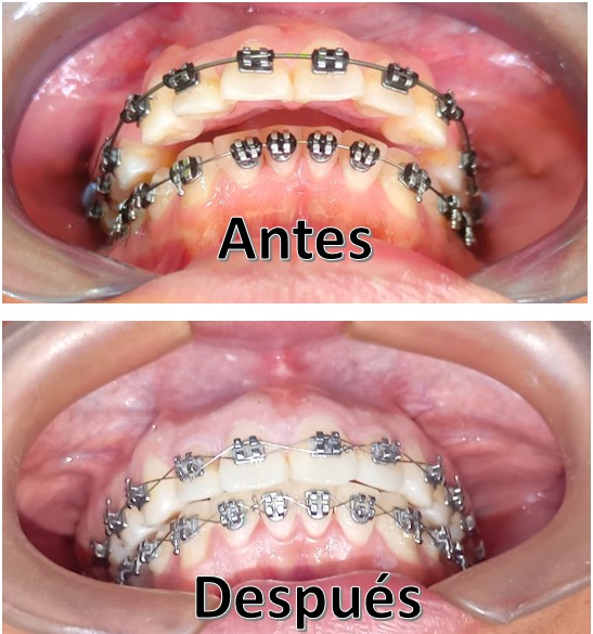 antesdespues1